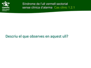 Síndrome de l’ull vermell sectorial
Síndrome de l’ull vermell sectorial sense clínica
d’alarma      sense clínica d’alarma Cas clínic 1.2.1
Cas clínic 1.2.1




Descriu el que observes en aquest ull?
 