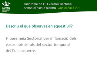 Síndrome de l’ull vermell sectorial
Síndrome de l’ull vermell sectorial sense clínica
d’alarma      sense clínica d’alarma Cas clínic 1.2.1




Descriu el que observes en aquest ull?

Hiperemeia Sectorial per inflamació dels
vasos episclerals del sector temporal
del l’ull esquerre.
 