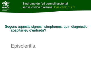 Síndrome de l’ull vermell sectorial
          sense clínica d’alarma Cas clínic 1.2.1




Segons aquests signes i símptomes, quin diagnòstic
   sospitaríeu d’entrada?



   Episcleritis.
 