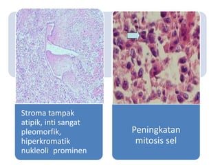 Stroma tampak
atipik, inti sangat
pleomorfik,
hiperkromatik
nukleoli prominen
Peningkatan
mitosis sel
 