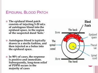 EPIDURAL BLOOD PATCH
 The epidural blood patch
consists of injecting 5-20 mLs
of autologous blood into the
epidural space, in the region
of the suspected dural 'hole.'
 Autologous blood is typically
drawn in a sterile fashion, and
then injected as a bolus into
the epidural space.
 In 90% of cases, the response
is positive and immediate.
Subsequently, long-term relief
of PDPH occurs in the
majority of cases
 