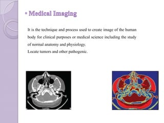 It is the technique and process used to create image of the human
body for clinical purposes or medical science including the study
of normal anatomy and physiology.
Locate tumors and other pathogenic.
 