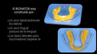 El BIONATOR esta
constituido por:
oUn arco labial (estimular
los labios)
oUn arco lingual
postura de la lengua)
oLos lazos laterales para
buccinadores (separar la
 
