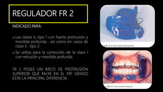 REGULADOR FR 2
INDICADO PARA:
o Las clases II, tipo 1 con fuerte protrusión y
mordida profunda , así como en casos de
clase II , tipo 2.
o Se utiliza para la corrección de la clase I
con retrusión y mordida profunda.
FR 2 POSEE UN ARCO DE PROTRUSIÓN
SUPERIOR QUE FALTA EN EL FR1 SIENDO
ESTA LA PRINCIPAL DIFERENCIA
 