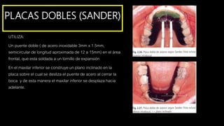 PLACAS DOBLES (SANDER)
UTILIZA:
Un puente doble ( de acero inoxidable 3mm x 1.5mm,
semicircular de longitud aproximada de 12 a 15mm) en el área
frontal, que esta soldada a un tornillo de expansión
En el maxilar inferior se construye un plano inclinado en la
placa sobre el cual se desliza el puente de acero al cerrar la
boca y de esta manera el maxilar inferior se desplaza hacia
adelante.
 
