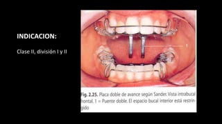 INDICACION:
Clase II, división I y II
 