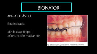 BIONATOR
APARATO BÁSICO
Esta indicado:
oEn la clase II tipo 1
oConstricción maxilar con
 