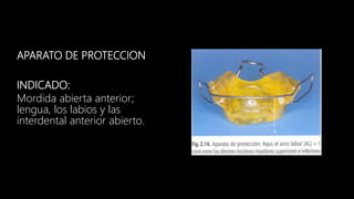 APARATO DE PROTECCION
INDICADO:
Mordida abierta anterior;
lengua, los labios y las
interdental anterior abierto.
 