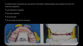 El sistema esta compuesto por accesorios removibles indispensables para realizar la función de
estimulo ortopédico.
• Los tampones linguales
• Escudos laterales
• El lip-bumper
• El arco para la tracción extraoral
 