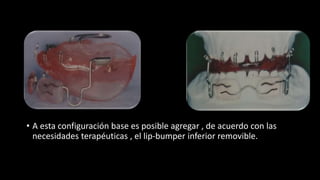 • A esta configuración base es posible agregar , de acuerdo con las
necesidades terapéuticas , el lip-bumper inferior removible.
 