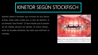 KINETOR SEGÚN STOCKFISCH
Aparato elástico bimaxilar que consiste de dos placas
activas, estas están unidas por un lazo de alambre, el
asi llamado “lazo kinetor”. El lazo impide que la presión
de las mejillas alcance los dientes. Al mismo tiempo ,
entre las arcadas dentarias hay tubos que estimulan la
mordida.
 
