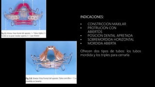 INDICACIONES:
• CONSTRICCION MAXILAR
• PROTRUCION CON
ABIERTOS
• POSICION DENTAL APRETADA
• SOBREMORDIDA HORIZONTAL
• MORDIDA ABIERTA
Ofrecen dos tipos de tubos: los tubos
mordida y los triples para cerrarla
 