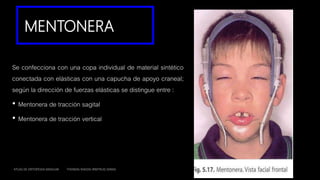 MENTONERA
Se confecciona con una copa individual de material sintético
conectada con elásticas con una capucha de apoyo craneal;
según la dirección de fuerzas elásticas se distingue entre :
• Mentonera de tracción sagital
• Mentonera de tracción vertical
ATLAS DE ORTOPEDIA MAXILAR THOMAS RAKOSI IRMTRUD JONAS
 