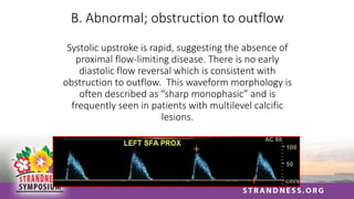 B. Abnormal; obstruction to outflow
Systolic upstroke is rapid, suggesting the absence of
proximal flow-limiting disease. There is no early
diastolic flow reversal which is consistent with
obstruction to outflow. This waveform morphology is
often described as “sharp monophasic” and is
frequently seen in patients with multilevel calcific
lesions.
 