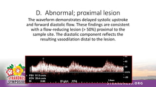 D. Abnormal; proximal lesion
The waveform demonstrates delayed systolic upstroke
and forward diastolic flow. These findings are consistent
with a flow-reducing lesion (> 50%) proximal to the
sample site. The diastolic component reflects the
resulting vasodilation distal to the lesion.
 