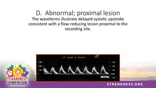D. Abnormal; proximal lesion
The waveforms illustrate delayed systolic upstroke
consistent with a flow-reducing lesion proximal to the
recording site.
 