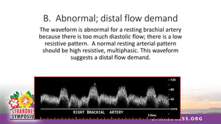 B. Abnormal; distal flow demand
The waveform is abnormal for a resting brachial artery
because there is too much diastolic flow; there is a low
resistive pattern. A normal resting arterial pattern
should be high resistive, multiphasic. This waveform
suggests a distal flow demand.
 