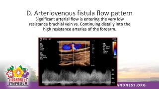 D. Arteriovenous fistula flow pattern
Significant arterial flow is entering the very low
resistance brachial vein vs. Continuing distally into the
high resistance arteries of the forearm.
 