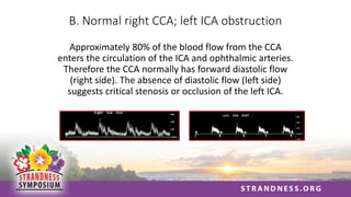 B. Normal right CCA; left ICA obstruction
Approximately 80% of the blood flow from the CCA
enters the circulation of the ICA and ophthalmic arteries.
Therefore the CCA normally has forward diastolic flow
(right side). The absence of diastolic flow (left side)
suggests critical stenosis or occlusion of the left ICA.
 