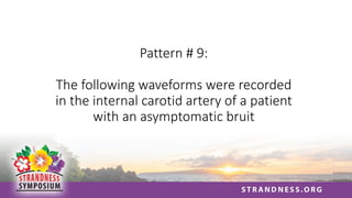 Pattern # 9:
The following waveforms were recorded
in the internal carotid artery of a patient
with an asymptomatic bruit
 