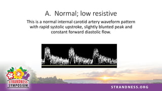 A. Normal; low resistive
This is a normal internal carotid artery waveform pattern
with rapid systolic upstroke, slightly blunted peak and
constant forward diastolic flow.
 