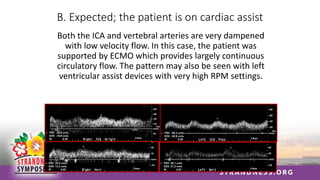 B. Expected; the patient is on cardiac assist
Both the ICA and vertebral arteries are very dampened
with low velocity flow. In this case, the patient was
supported by ECMO which provides largely continuous
circulatory flow. The pattern may also be seen with left
ventricular assist devices with very high RPM settings.
 