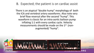 B. Expected; the patient is on cardiac assist
There is an atypical “double hump” morphology of both
the ICA and vertebral artery waveforms. Also note very
brief flow reversal after the second “hump”. This
waveform is classic for an intra-aortic balloon pump
inflating 1:1 with every cardiac cycle. Velocity
measurements should be made on the 1st (non-
augmented) “hump”.
 