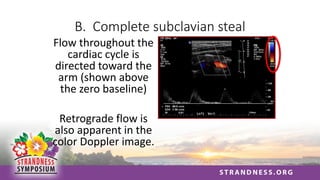 B. Complete subclavian steal
Flow throughout the
cardiac cycle is
directed toward the
arm (shown above
the zero baseline)
Retrograde flow is
also apparent in the
color Doppler image.
 
