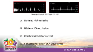 Yesenko S, et al. JVU 2008; 32:152.
A. Normal; high resistive
B. Bilateral ICA occlusion
C. Cerebral circulatory arrest
D. Sonographer error; ECA waveforms
 