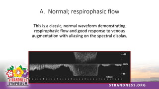A. Normal; respirophasic flow
This is a classic, normal waveform demonstrating
respirophasic flow and good response to venous
augmentation with aliasing on the spectral display.
 