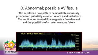 D. Abnormal; possible AV fistula
This subclavian flow pattern demonstrates unusually
pronounced pulsatility, elevated velocity and turbulence.
The continuous forward flow suggests a flow demand
and the possibility of an arteriovenous fistula.
 