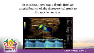 In this case, there was a fistula from an
arterial branch of the thyrocervical trunk to
the subclavian vein.
 