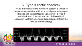 B. Type II aortic endoleak
This bi-directional to-fro waveform pattern is similar to
the pattern associated with an arterial pseudoaneurysm.
It is also the classic Doppler signature of a Type II
endoleak with flow into and out of the residual
aneurysm sac from an arterial branch (usually from the
IMA or lumbar artery)
 