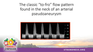 The classic “to-fro” flow pattern
found in the neck of an arterial
pseudoaneurysm
 