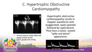 C. Hypertrophic Obstructive
Cardiomyopathy
Hypertrophic obstructive
cardiomyopathy results in
Doppler waveforms with
exaggerated, rapid upstroke
followed by rapid decent.
They have a classic systolic
“spike and dome”
appearance.
• Severe anterior leaflet SAM with
septal contact at rest
• LVOT gradient 90 mmHg
 