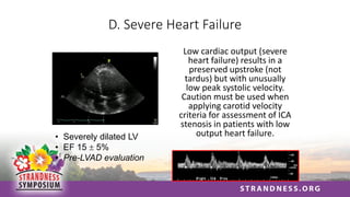 D. Severe Heart Failure
Low cardiac output (severe
heart failure) results in a
preserved upstroke (not
tardus) but with unusually
low peak systolic velocity.
Caution must be used when
applying carotid velocity
criteria for assessment of ICA
stenosis in patients with low
output heart failure.
• Severely dilated LV
• EF 15  5%
• Pre-LVAD evaluation
 