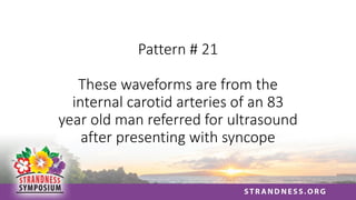 Pattern # 21
These waveforms are from the
internal carotid arteries of an 83
year old man referred for ultrasound
after presenting with syncope
 