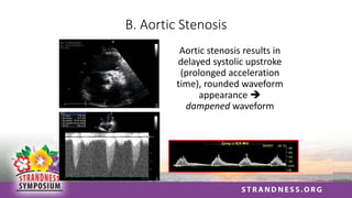 B. Aortic Stenosis
Aortic stenosis results in
delayed systolic upstroke
(prolonged acceleration
time), rounded waveform
appearance ➔
dampened waveform
• AVA 0.72 cm2
• Pk/mn 70/40 mmHg
 