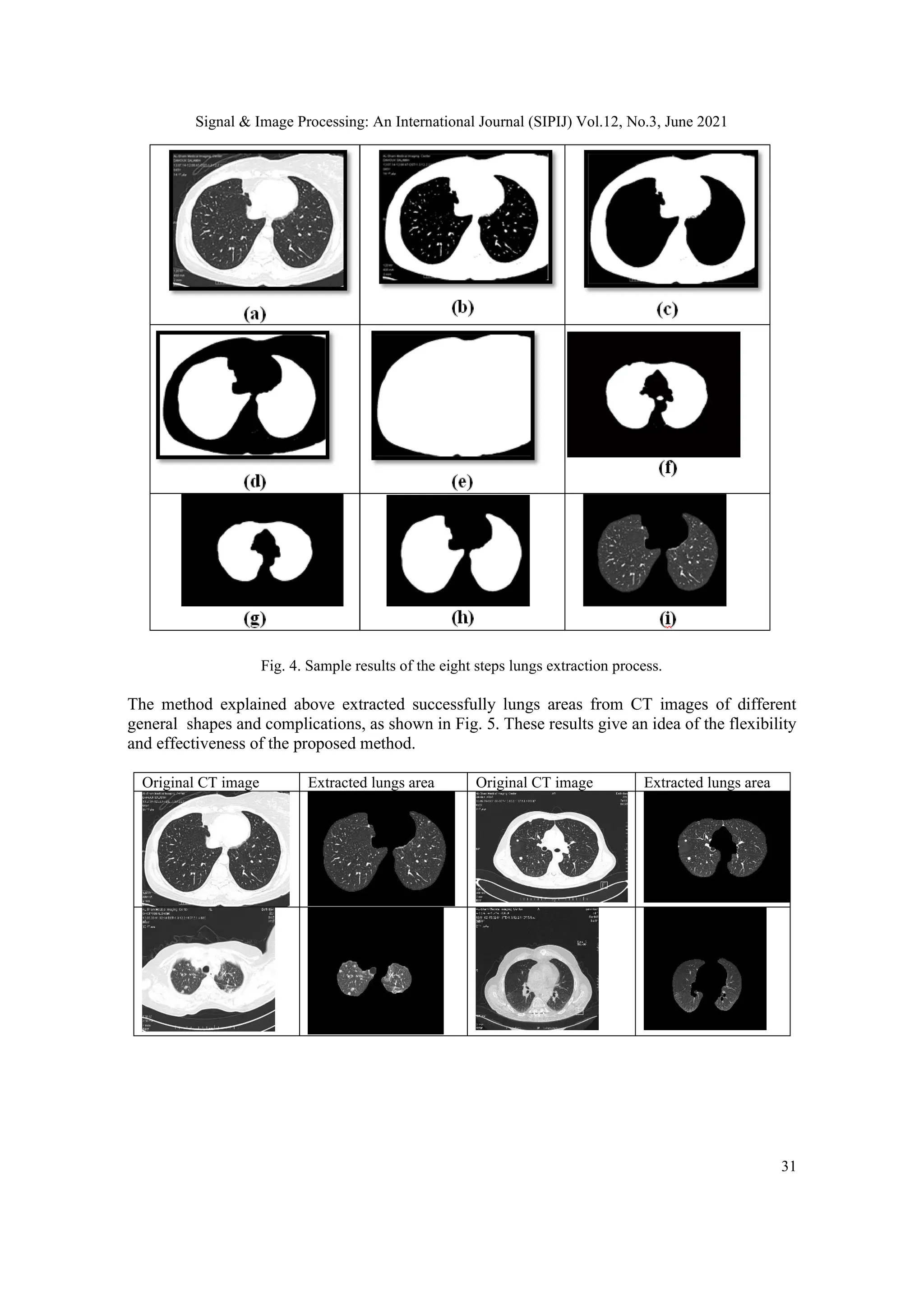 Signal & Image Processing: An International Journal (SIPIJ) Vol.12, No.3, June 2021
31
Fig. 4. Sample results of the eight steps lungs extraction process.
The method explained above extracted successfully lungs areas from CT images of different
general shapes and complications, as shown in Fig. 5. These results give an idea of the flexibility
and effectiveness of the proposed method.
Original CT image Extracted lungs area Original CT image Extracted lungs area
 