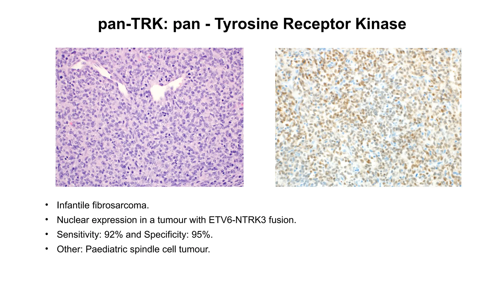 pan-TRK: pan - Tyrosine Receptor Kinase
• Infantile fibrosarcoma.
• Nuclear expression in a tumour with ETV6-NTRK3 fusion.
• Sensitivity: 92% and Specificity: 95%.
• Other: Paediatric spindle cell tumour.
 