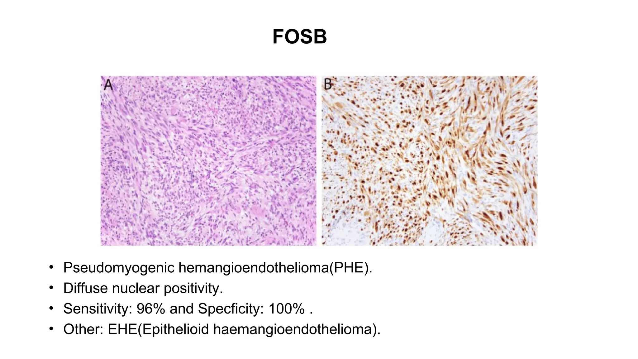FOSB
• Pseudomyogenic hemangioendothelioma(PHE).
• Diffuse nuclear positivity.
• Sensitivity: 96% and Specficity: 100% .
• Other: EHE(Epithelioid haemangioendothelioma).
 