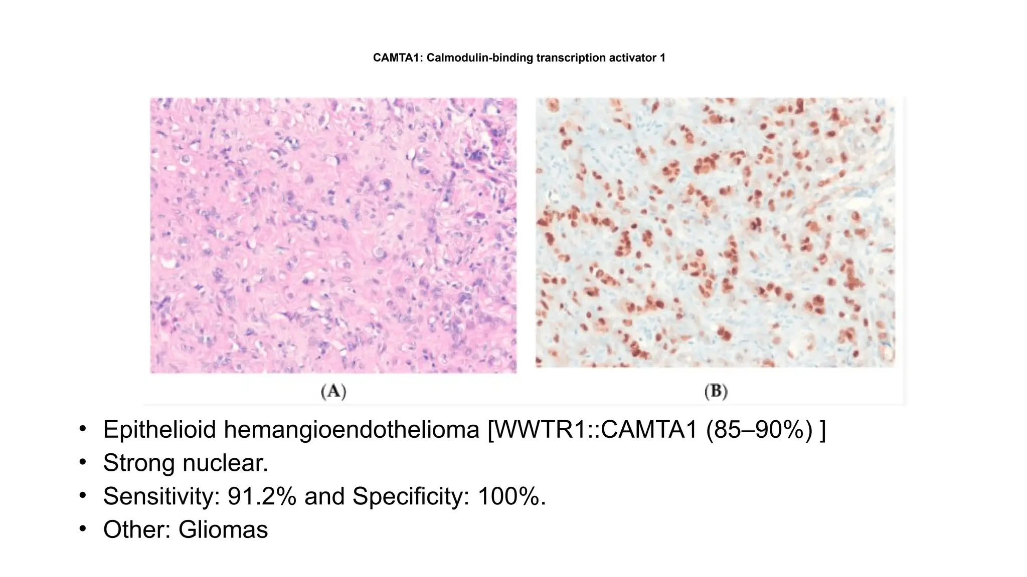 CAMTA1: Calmodulin-binding transcription activator 1
• Epithelioid hemangioendothelioma [WWTR1::CAMTA1 (85–90%) ]
• Strong nuclear.
• Sensitivity: 91.2% and Specificity: 100%.
• Other: Gliomas
 