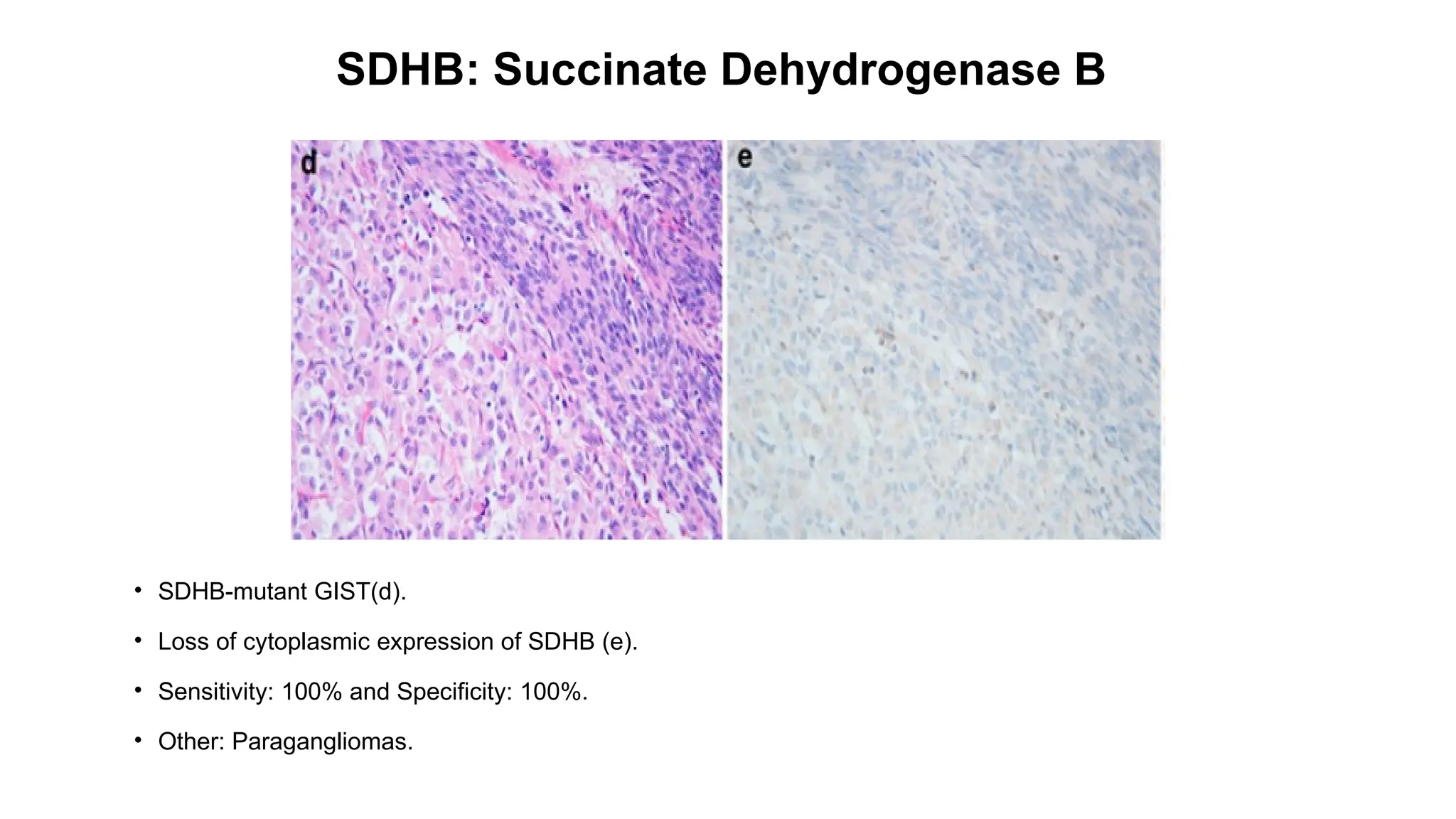 SDHB: Succinate Dehydrogenase B
• SDHB-mutant GIST(d).
• Loss of cytoplasmic expression of SDHB (e).
• Sensitivity: 100% and Specificity: 100%.
• Other: Paragangliomas.
 