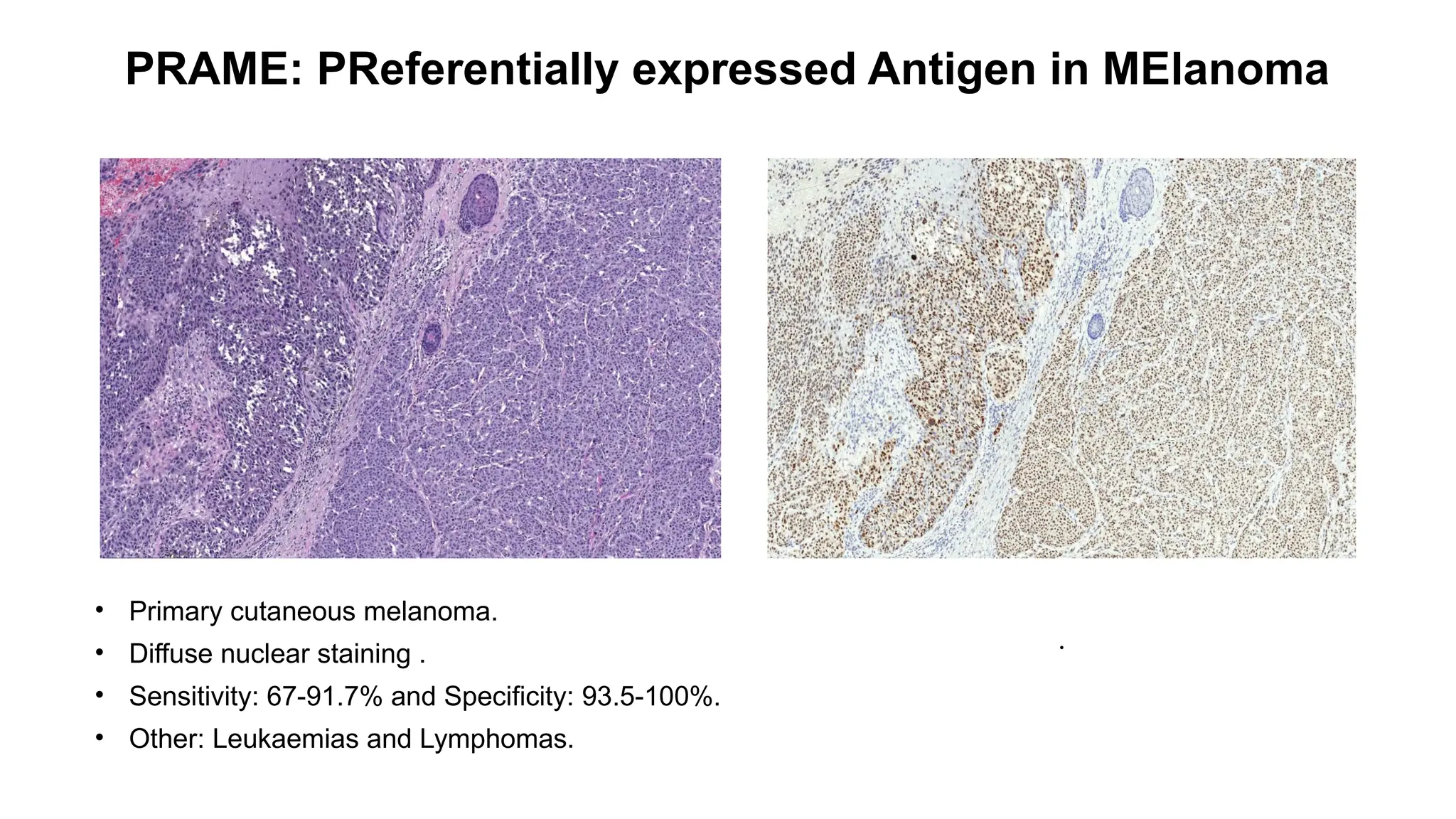 PRAME: PReferentially expressed Antigen in MElanoma
.
• Primary cutaneous melanoma.
• Diffuse nuclear staining .
• Sensitivity: 67-91.7% and Specificity: 93.5-100%.
• Other: Leukaemias and Lymphomas.
 