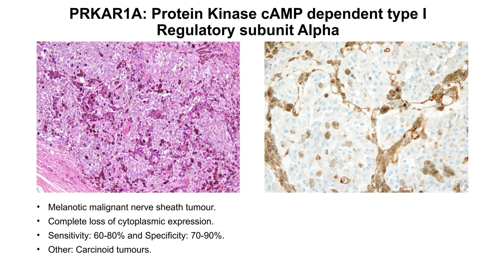 PRKAR1A: Protein Kinase cAMP dependent type I
Regulatory subunit Alpha
• Melanotic malignant nerve sheath tumour.
• Complete loss of cytoplasmic expression.
• Sensitivity: 60-80% and Specificity: 70-90%.
• Other: Carcinoid tumours.
 