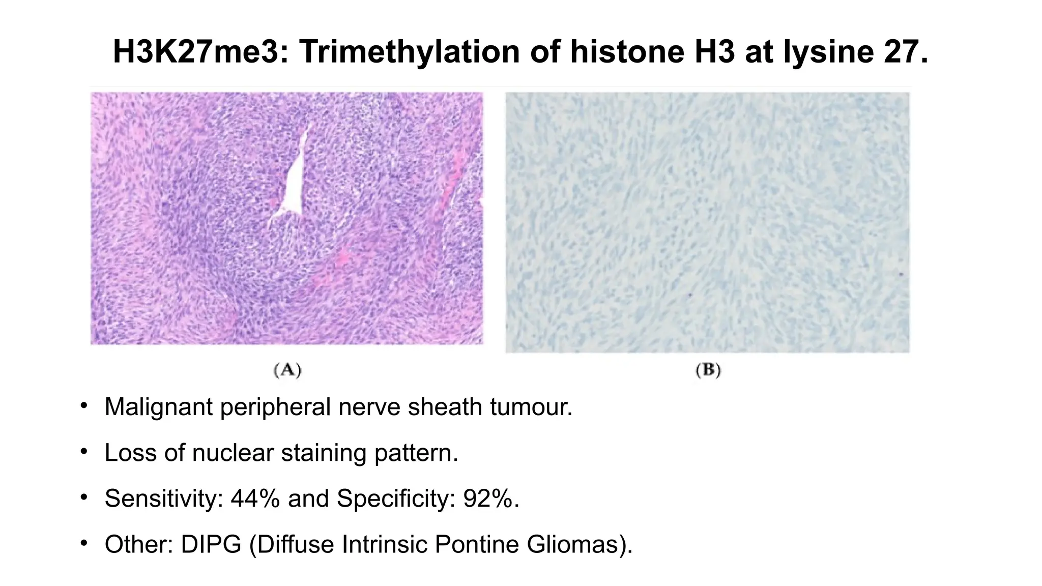 H3K27me3: Trimethylation of histone H3 at lysine 27.
• Malignant peripheral nerve sheath tumour.
• Loss of nuclear staining pattern.
• Sensitivity: 44% and Specificity: 92%.
• Other: DIPG (Diffuse Intrinsic Pontine Gliomas).
 