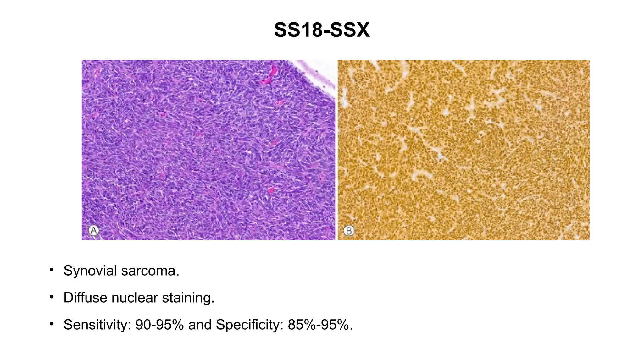 SS18-SSX
• Synovial sarcoma.
• Diffuse nuclear staining.
• Sensitivity: 90-95% and Specificity: 85%-95%.
 