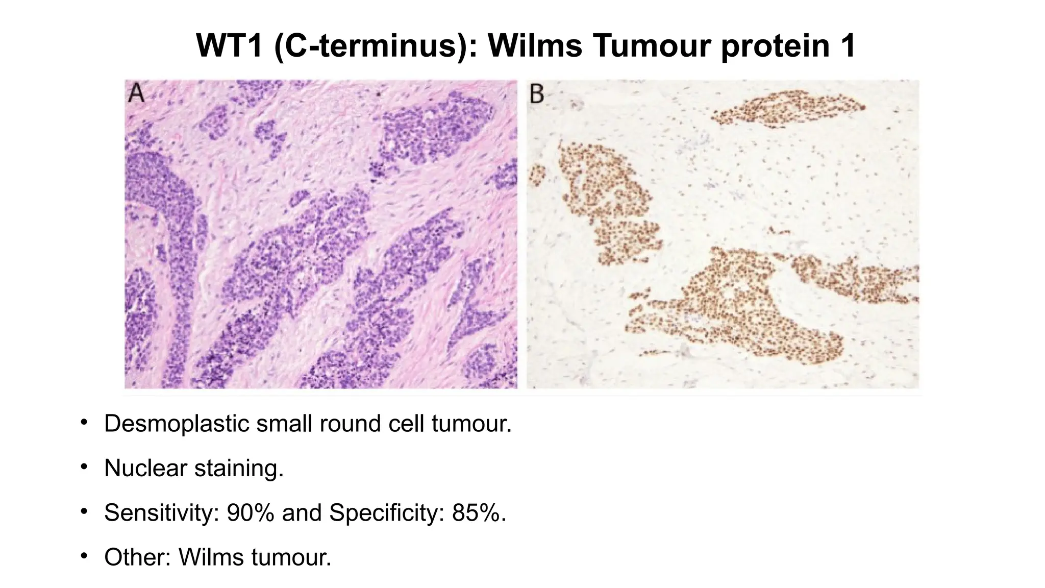WT1 (C-terminus): Wilms Tumour protein 1
• Desmoplastic small round cell tumour.
• Nuclear staining.
• Sensitivity: 90% and Specificity: 85%.
• Other: Wilms tumour.
 
