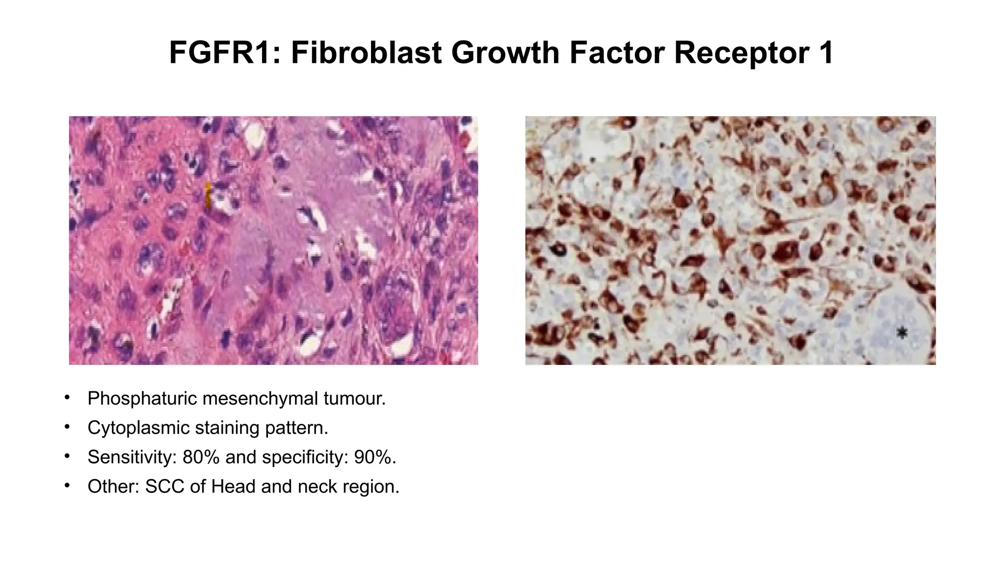 FGFR1: Fibroblast Growth Factor Receptor 1
• Phosphaturic mesenchymal tumour.
• Cytoplasmic staining pattern.
• Sensitivity: 80% and specificity: 90%.
• Other: SCC of Head and neck region.
 