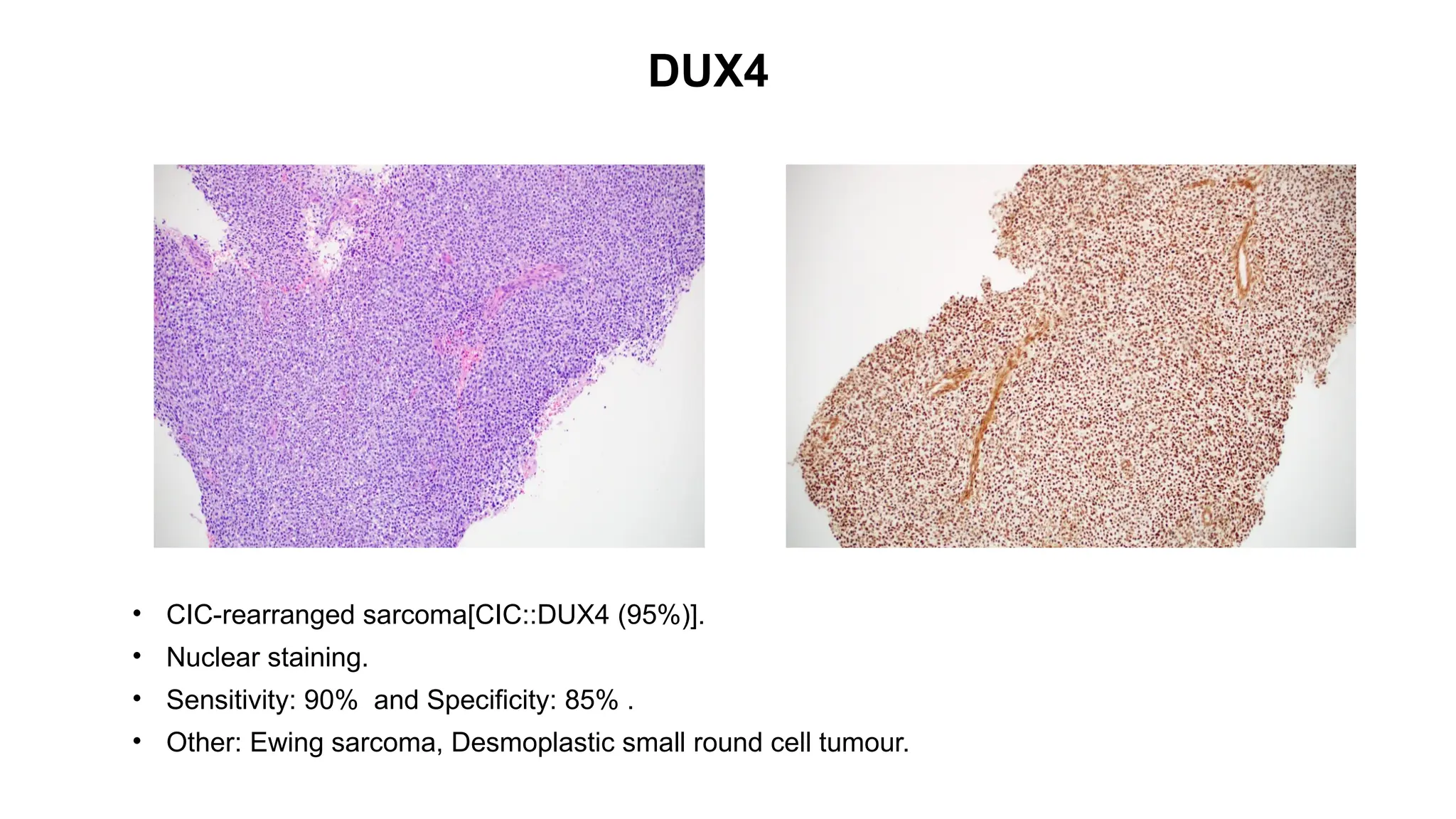 DUX4
• CIC-rearranged sarcoma[CIC::DUX4 (95%)].
• Nuclear staining.
• Sensitivity: 90% and Specificity: 85% .
• Other: Ewing sarcoma, Desmoplastic small round cell tumour.
 